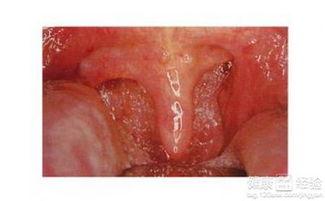 喉炎可以吃白瓜吗,白瓜的食疗作用解析