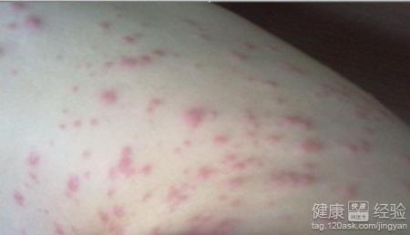 吃藤瓜过敏,探寻过敏源与应对策略